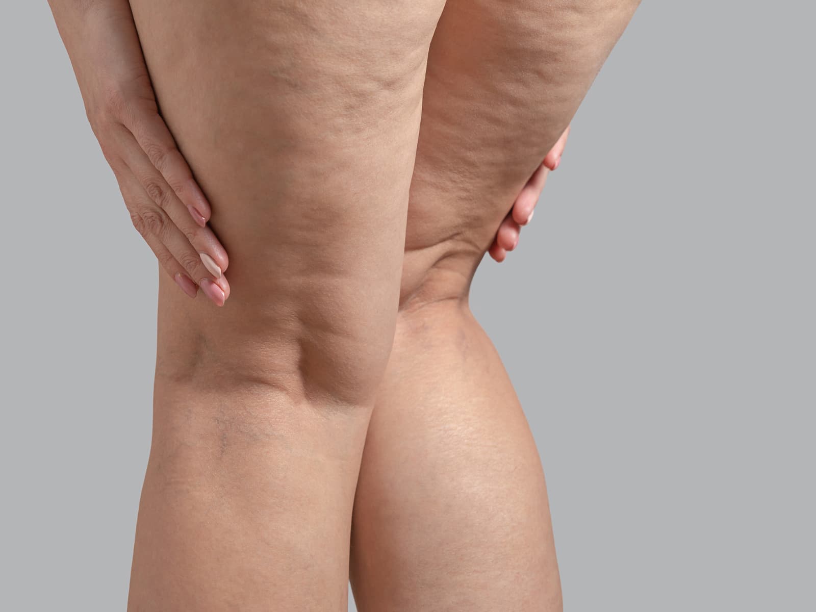 Lipödem und hormonelle Veränderungen: Der Einfluss von Pubertät und Wechseljahren