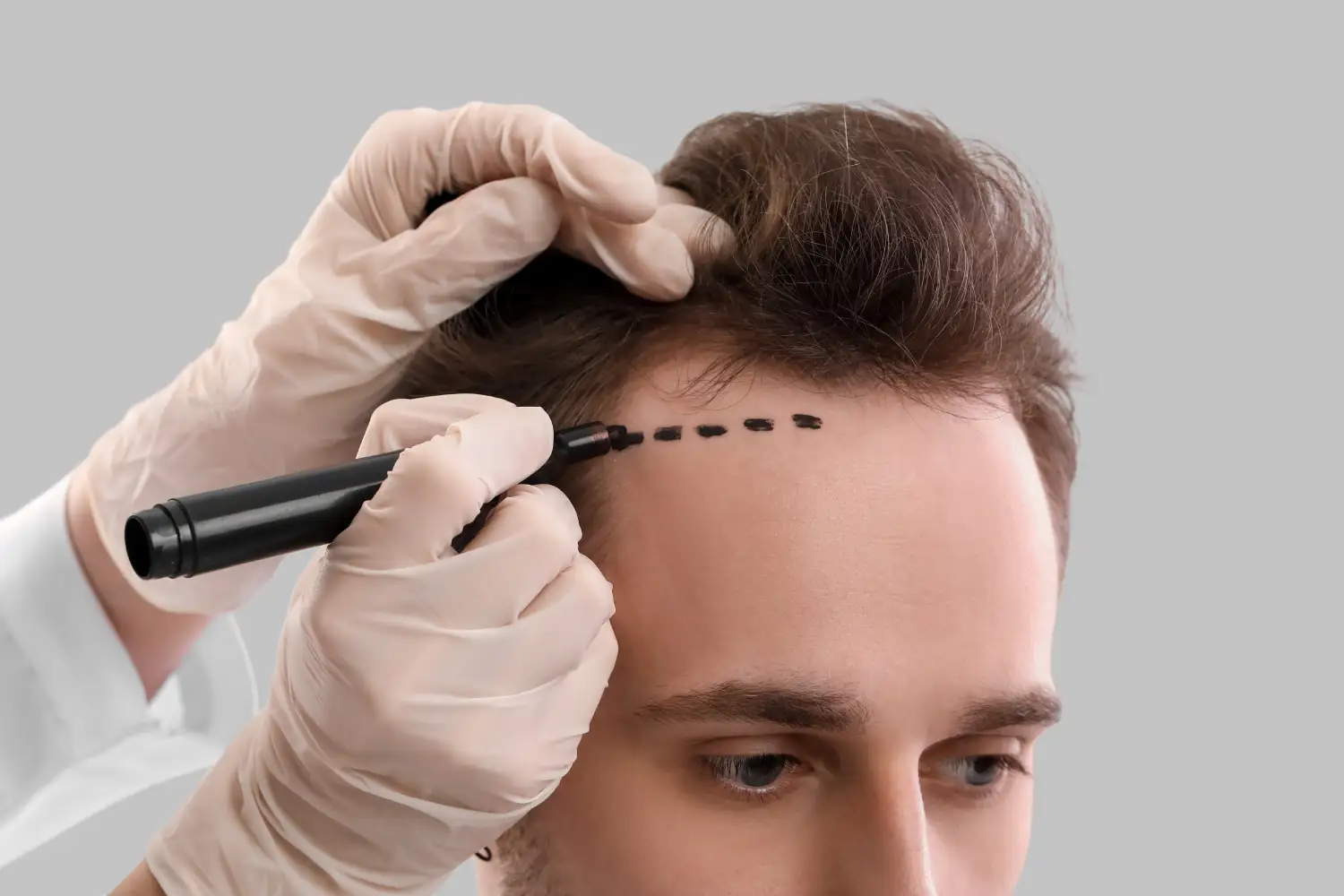 Haartransplantation türkei bei dünnem Haar: Möglichkeiten zur Verdichtung